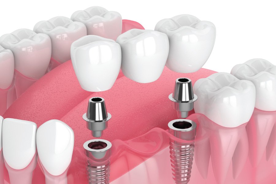 North Bend Implant-Supported Bridges