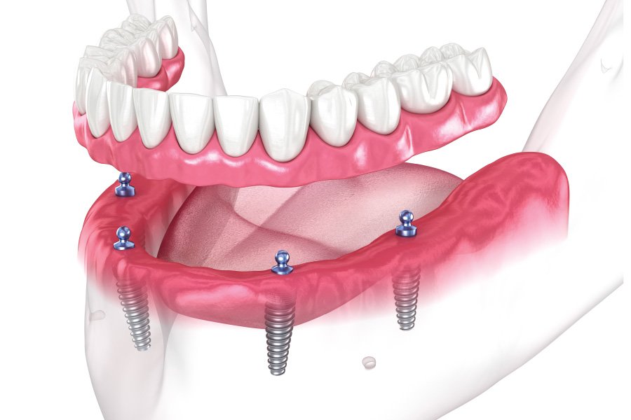 North Bend Implant-Supported Dentures