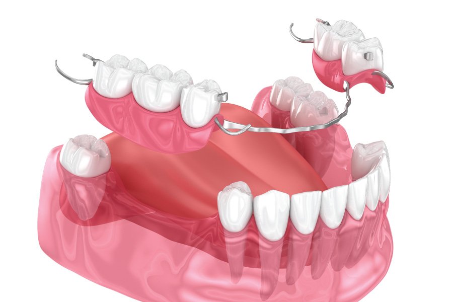 North Bend Partial Dentures