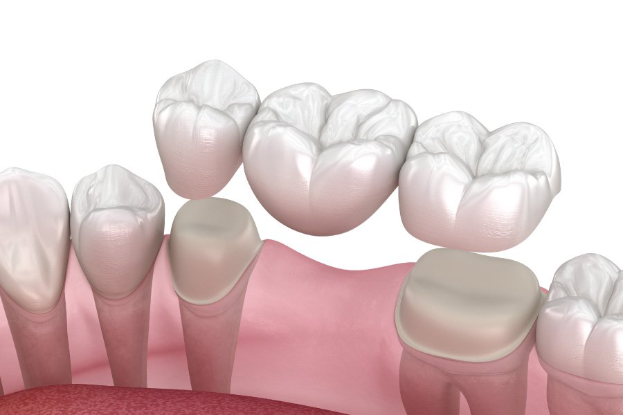 North Bend Traditional Bridges